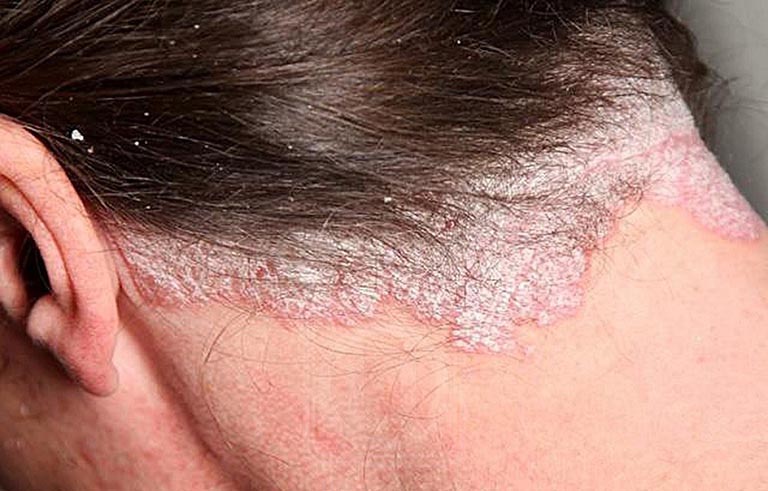 Dấu hiệu nhận biết và phương pháp điều trị bệnh á sừng da đầu