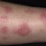 Dấu hiệu nhận biết và cách điều trị bệnh chàm (Eczema)