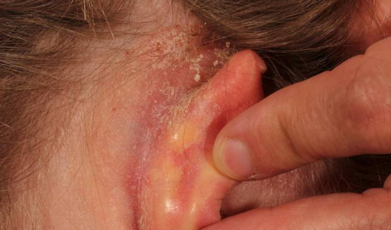 Dấu hiệu nhận biết và phương pháp điều trị bệnh chàm tai