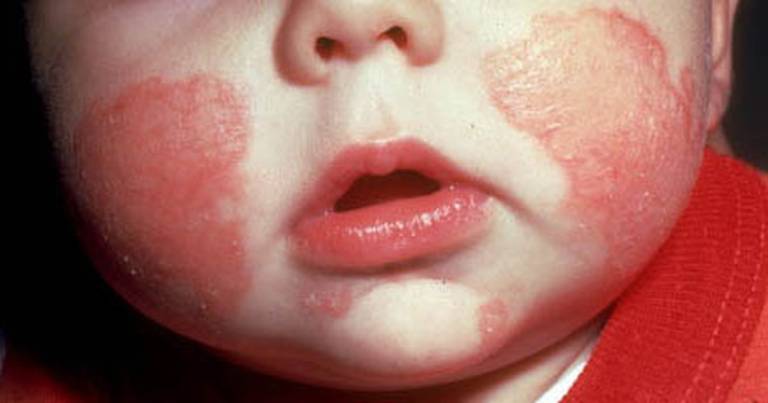 Dấu hiệu nhận biết và phương pháp điều trị bệnh Eczema ở trẻ em