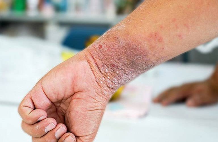 Các triệu chứng bệnh Eczema ở trẻ