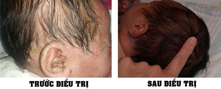 Hình ảnh trước và sau khi điều trị viêm da tiết bã ở trẻ em tại Thuốc dân tộc
