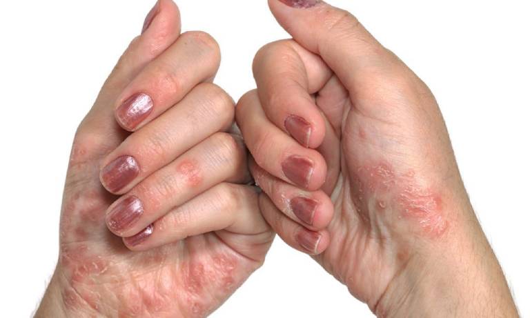 Vùng da tổn thương có màu đỏ đặc trưng, khi sờ vào bề mặt da sẽ có cảm giác cộm như vỏ sò