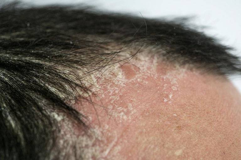 Các triệu chứng của bệnh vảy nến da đầu khiến người bệnh khó chịu và dễ gây ra tình trạng rụng tóc