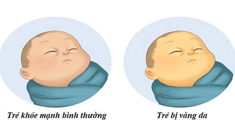 Trẻ sơ sinh bị vàng da