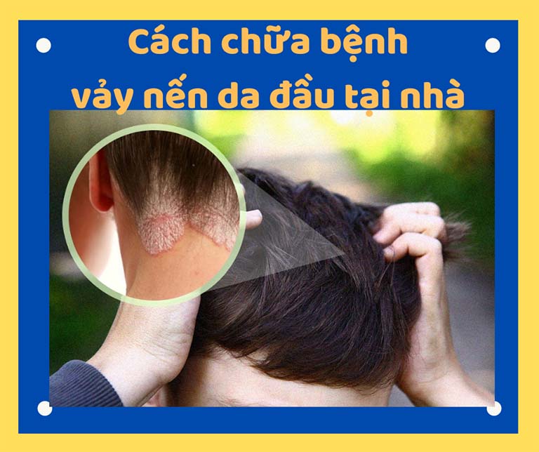7 cách chữa bệnh vảy nến da đầu tại nhà an toàn hiệu quả