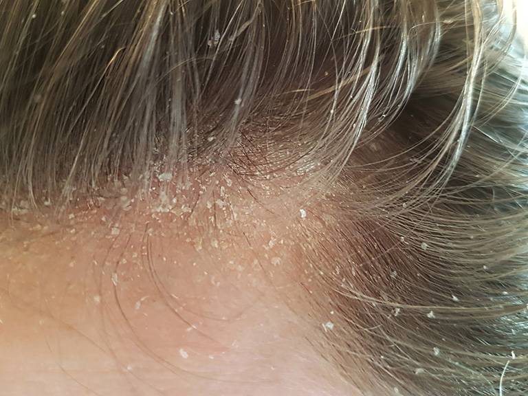 Dấu hiệu nhận biết và cách điều trị dứt điểm bệnh chàm da đầu