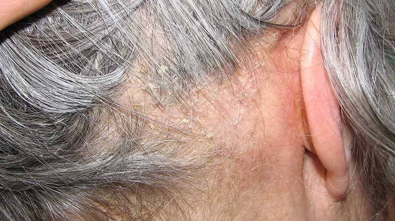 Dấu hiệu nhận biết chàm da đầu ở người trưởng thành