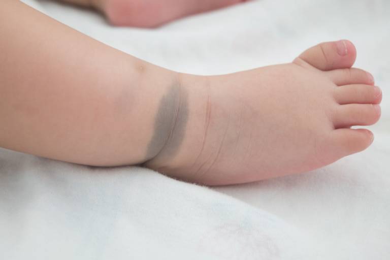 Vết chàm xanh ở trẻ sơ sinh có tự hết không? Có đáng lo?