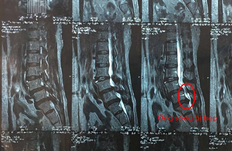Một số hình ảnh thoát vị đĩa đệm được chụp cộng hưởng từ MRI