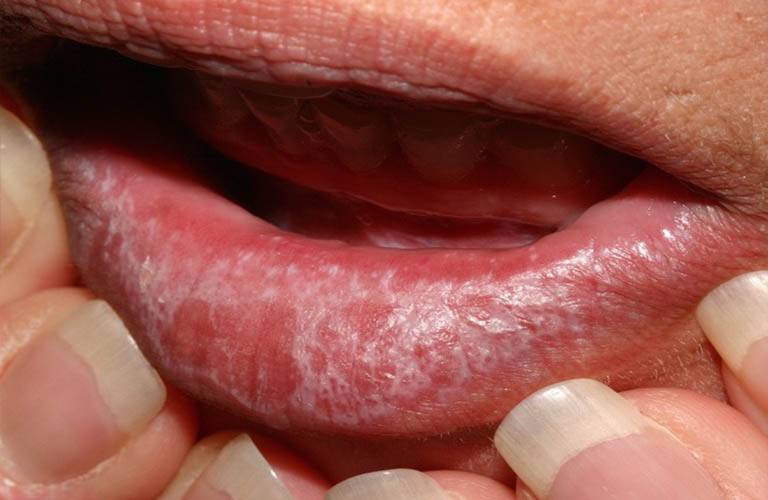 Xơ hóa Lichen gây nổi đốm trắng không ngứa trên da