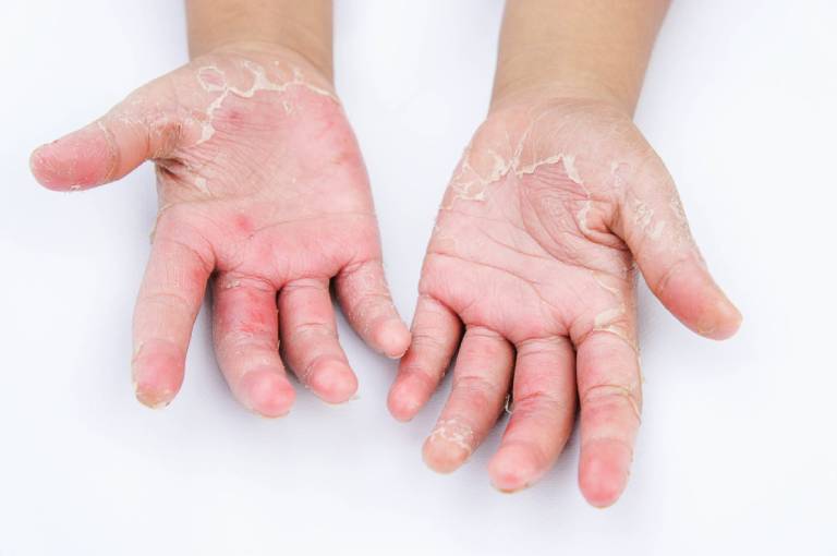 Phương pháp điều trị bênh da tróc vảy do chàm khô