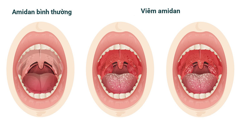 Đau họng nổi hạch dưới hàm