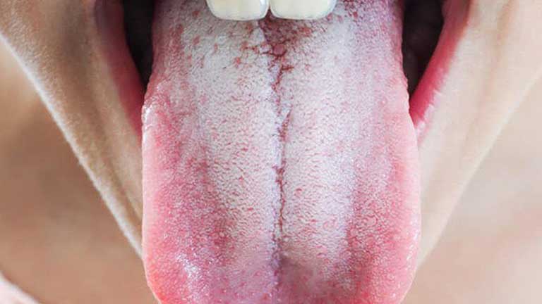 Lưỡi trắng đau họng là bệnh gì? Có nguy hiểm không?