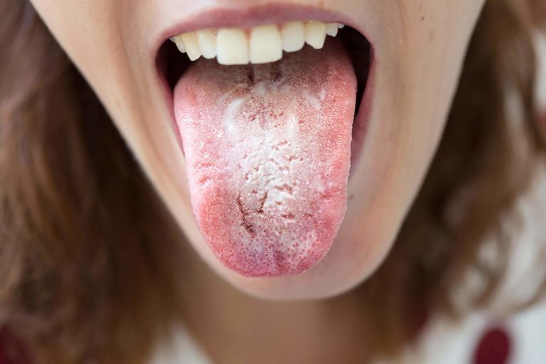 Bị lưỡi trắng đau họng khi nào cần khám bác sĩ?