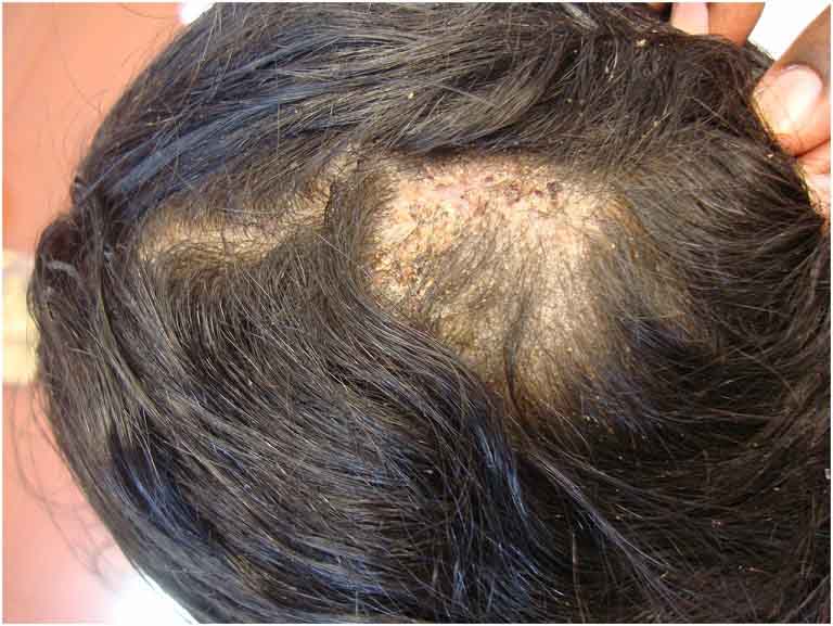 Dấu hiệu nhận biết và phương pháp điều trị bệnh nấm da đầu