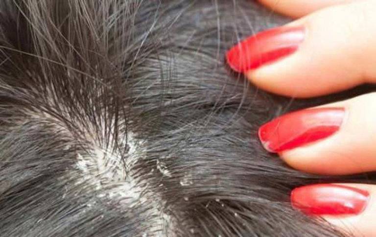 Phương pháp điều trị và phục hồi tóc khi bị nấm da đầu gây rụng tóc
