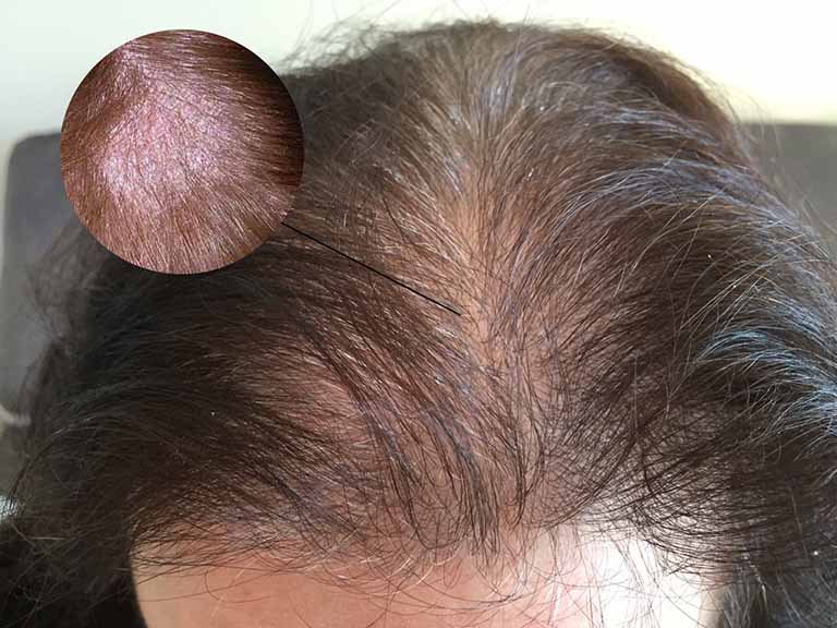 Dấu hiệu nhận biết và cách khắc phụ bệnh nấm da đầu ở người lớn