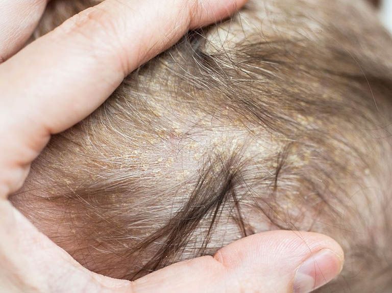 Dấu hiệu nhận biết và phương pháp điều trị nấm da đầu ở trẻ em