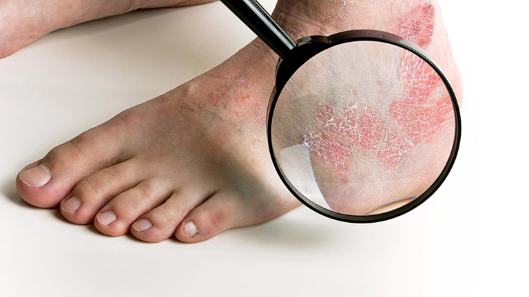 Dấu hiệu nhận biết cách điều trị dứt điểm bệnh nấm da tay, chân