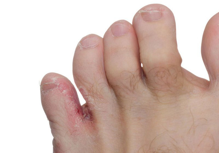 Nguyên nhân dẫn đến hiện tượng ngứa kẽ ngón tay, ngón chân