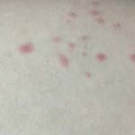Xuất hiện các chấm đỏ trên da như nốt ruồi son là dấu hiệu của bệnh gì?