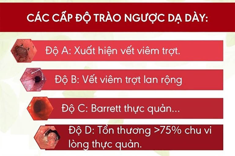 Trào ngược dạ dày độ A