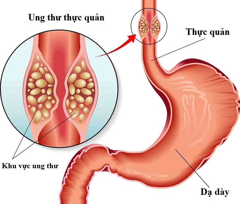 trào ngược dạ dày gây khó thở