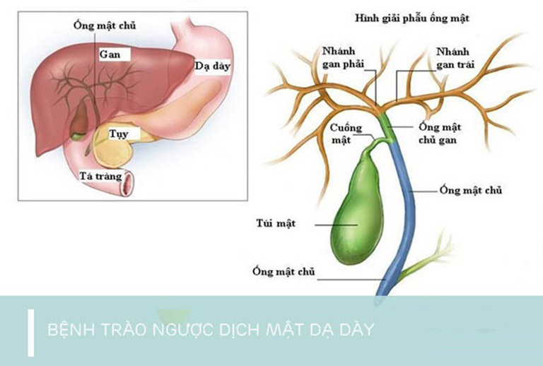 Trào ngược dịch mật