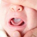 Nguyên nhân và cách điều trị dứt điểm hiện tượng trẻ bị nấm miệng