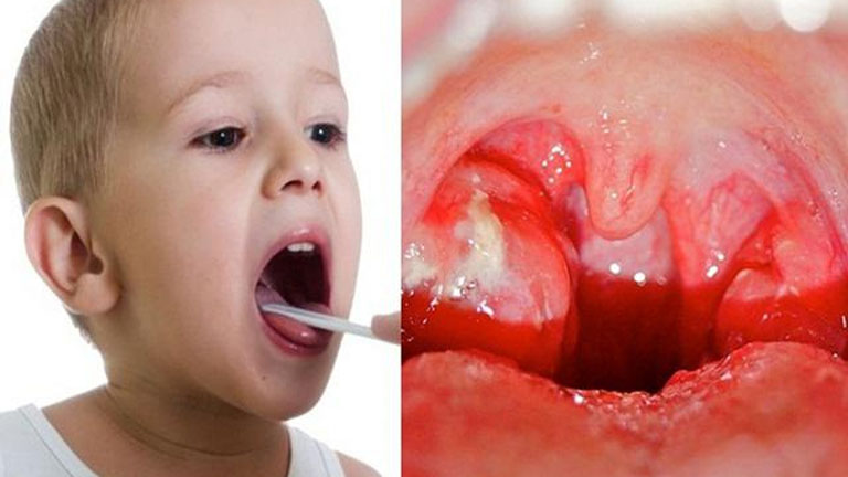 Phương pháp điều trị cho Trẻ bị viêm amidan có mủ