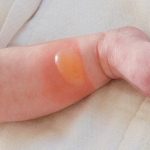 Nguyên nhân và cách chữa trị dứt điểm trẻ sơ sinh bị phồng rộp da