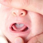 Cách chăm sóc và điều trị cho trẻ sơ sinh bị nhiệt miệng, lở miệng