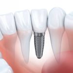 Review 10 địa chỉ trồng răng – cấy ghép Implant tốt nhất Hà Nội