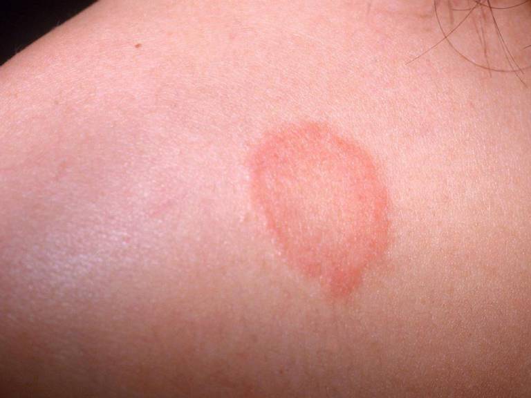 Xuất hiện vết tròn đỏ trên da không ngứa là bệnh gì?