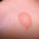 Vết tròn đỏ trên da không ngứa là dấu hiệu của bệnh gì?