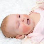 Cách chăm sóc và điều trị dứt điểm viêm da cơ địa ở trẻ sơ sinh