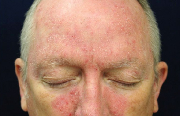 Dấu hiệu nhận biết và phương pháp điều trị Viêm da dầu ở mặt
