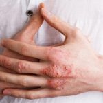 Dấu hiệu nhận biết và cách điều trị Bệnh viêm da tiếp xúc