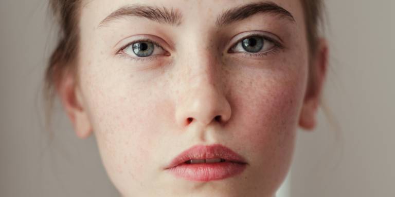 Dấu hiệu nhận biết và cách xử lý viêm da tiếp xúc dị ứng ở mặt
