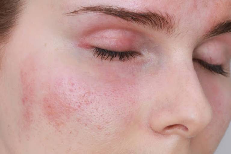 Dấu hiệu bệnh viêm da tiếp xúc dị ứng ở mặt