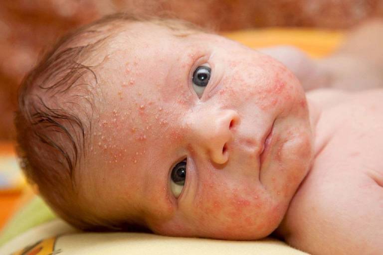 Viêm da tiếp xúc ở trẻ em: Cách điều trị và phòng ngừa
