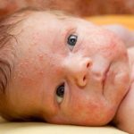 Dấu hiệu nhận biết và cách điều trị bệnh Viêm da tiếp xúc ở trẻ em