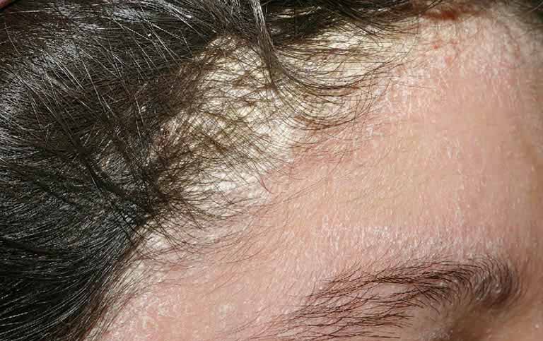Dấu hiệu nhận biết và cách điều trị bệnh viêm da tiết bã nhờn da đầu