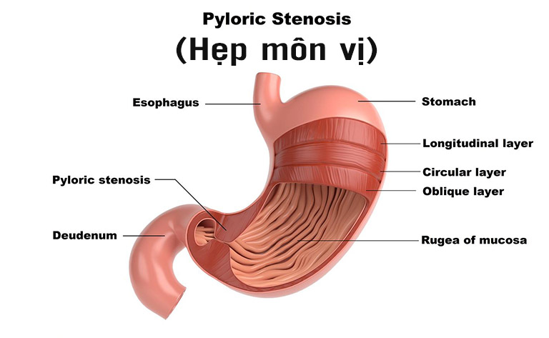 Viêm hang vị dạ dày có nguy hiểm không