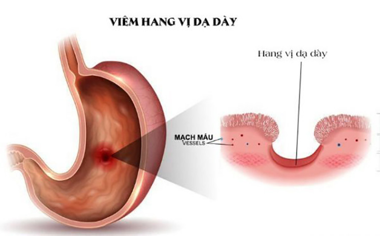 Viêm hang vị dạ dày có nguy hiểm không