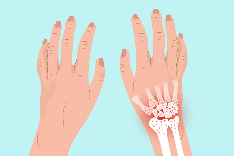 Nguyên nhân và phương pháp điều trị Viêm khớp cổ tay