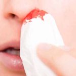 Xuất hiện triệu chứng “Viêm xoang chảy máu mũi” cảnh báo nguy hiểm đến sức khỏe