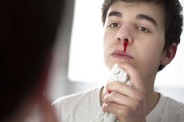 Điều trị viêm xoang chảy máu mũi thế nào?